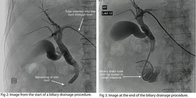 Biliary Tract Diseases