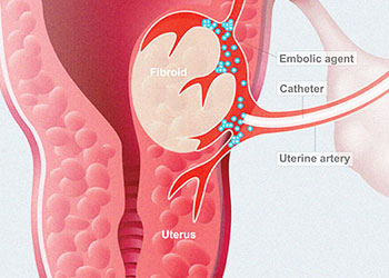Uterine Artery Embolization For Fibroids