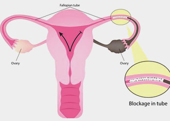 Female Infertility Treatment in Delhi, India