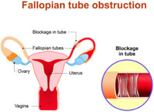 fallopian tubes obstruction