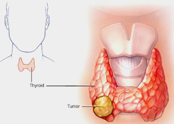 Thyroid Nodule Ablation